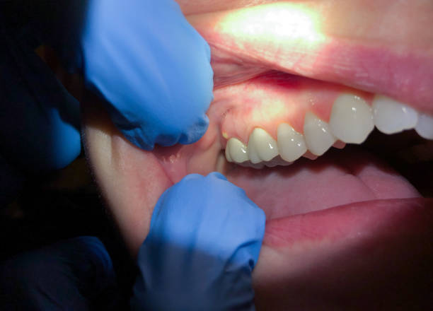 Best Emergency Wisdom Teeth Removal in Oneida, TN
